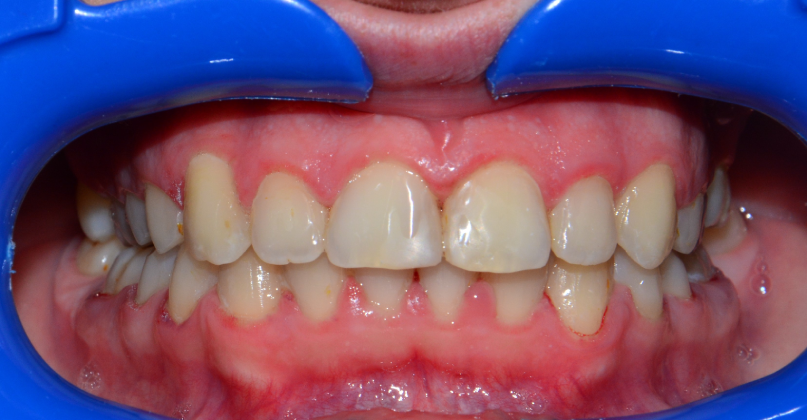 Leczenie ortodontyczne