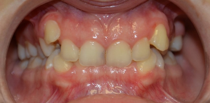 Leczenie ortodontyczne