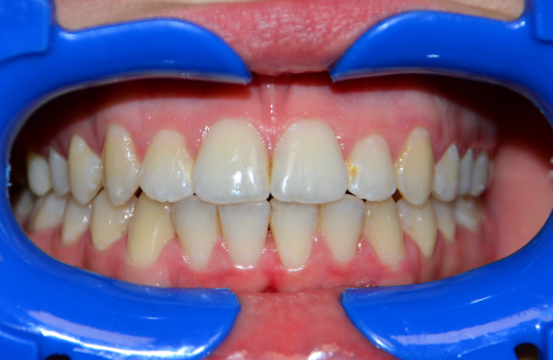 Leczenie ortodontyczne