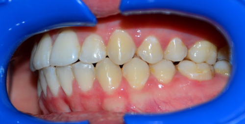 Leczenie ortodontyczne