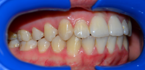 Leczenie ortodontyczne