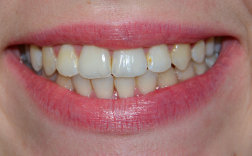 Leczenie ortodontyczne