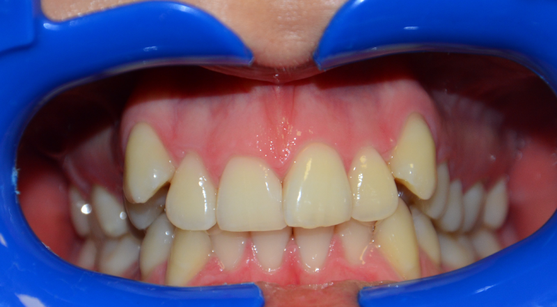 Leczenie ortodontyczne