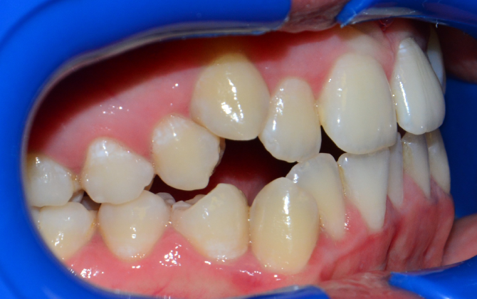 Leczenie ortodontyczne