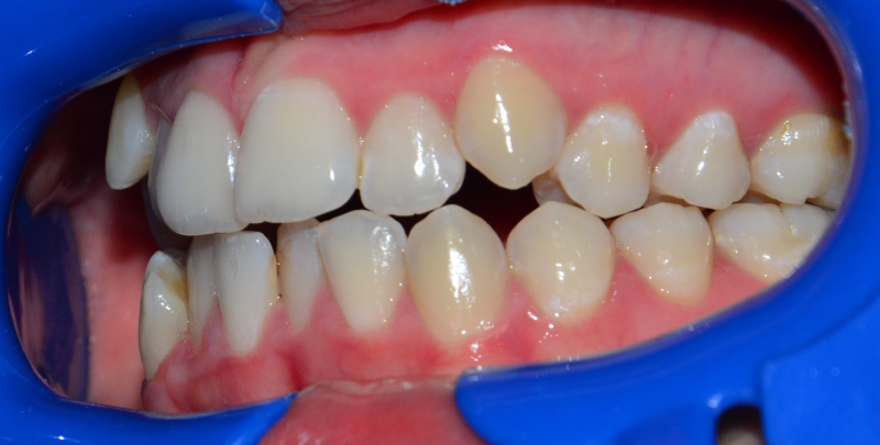 Leczenie ortodontyczne