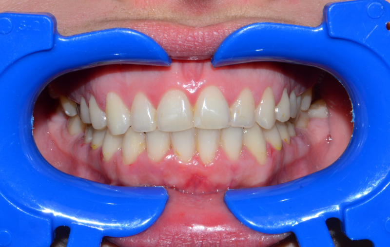 Leczenie ortodontyczne