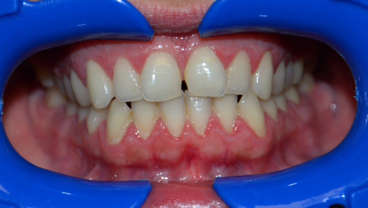 Leczenie ortodontyczne